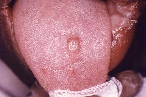 syphilis female