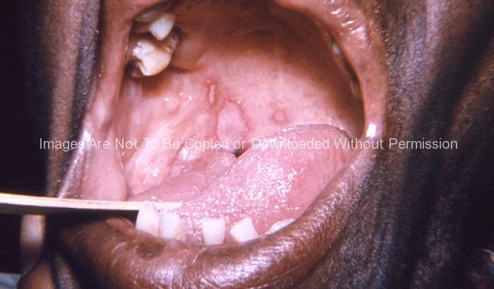 Closeup Of An Elderly AfricanAmerican Female Patients Oral Cavity