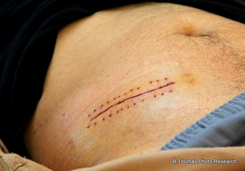 Stiches on a Stomach (medical stock photo)