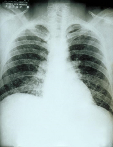 Chest X-Ray (influenza)