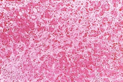 Cytoarchitectural Changes Found in a Liver Tissue Specimen Extracted from an Ebola Patient