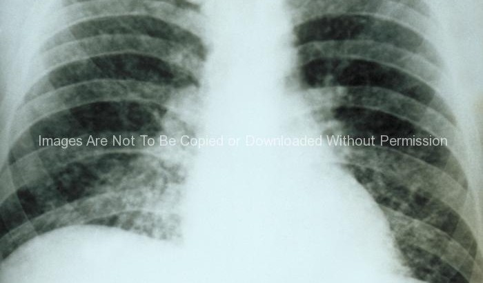 Chest X-Ray - diffuse pulmonary infiltration due to acute pulmonary histoplasmosis